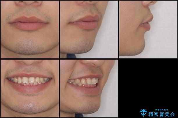 インビザラインによる、すきっ歯の改善の治療前（顔貌）
