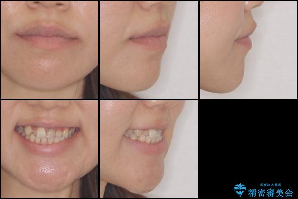 前歯の反対咬合　非抜歯のワイヤー矯正の治療前（顔貌）