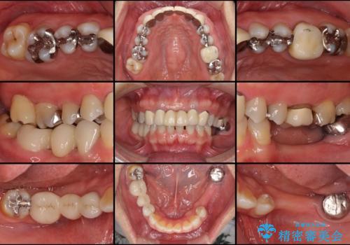 飛行機を利用しての通院 気になる所を全て治療する総合歯科治療の治療前