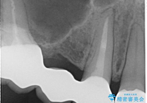 セラミックと矯正を併用してきれいな前歯への治療後