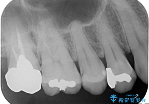 精密なむし歯の治療 ゴールドインレーの治療前