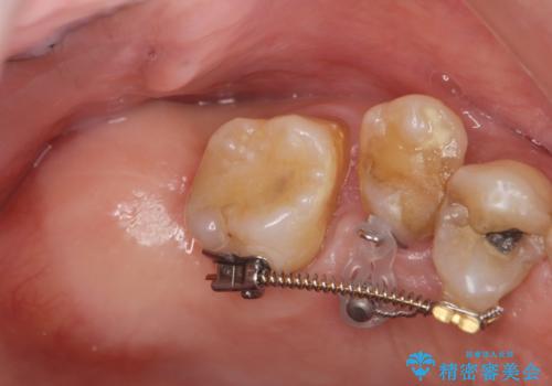 部分矯正を含む 歯周病治療 (再生治療・歯周ポケット除去・MTM・連結補綴)の治療前