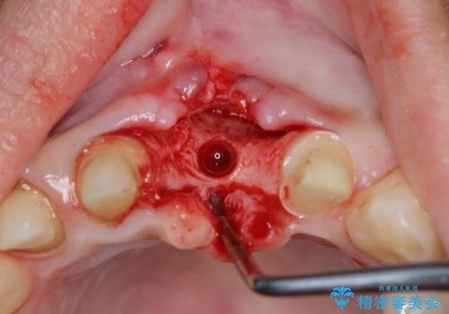 不良インプラントの除去・骨造成・歯肉移植・前歯審美セラミックブリッジ製作の治療中