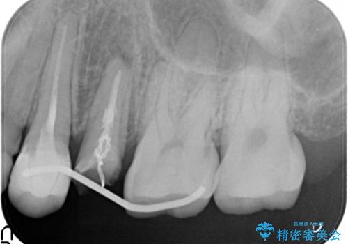 歯肉の中までの深い虫歯　部分矯正後のセラミック治療の治療後