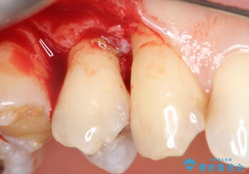 部分矯正を含む 歯周病治療 (再生治療・歯周ポケット除去・MTM・連結補綴)の治療中