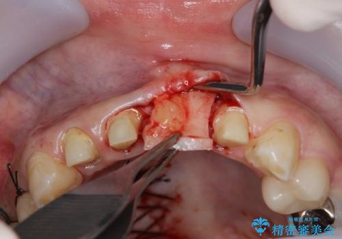 不良インプラントの除去・骨造成・歯肉移植・前歯審美セラミックブリッジ製作の治療前