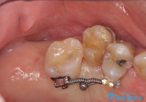 部分矯正を含む 歯周病治療 (再生治療・歯周ポケット除去・MTM・連結補綴)の治療前