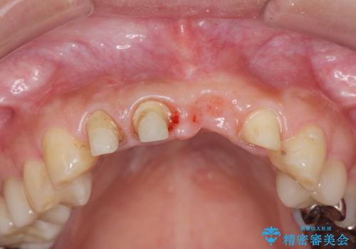 不良インプラントの除去・骨造成・歯肉移植・前歯審美セラミックブリッジ製作の治療中