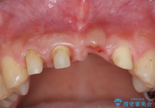 不良インプラントの除去・骨造成・歯肉移植・前歯審美セラミックブリッジ製作の治療中