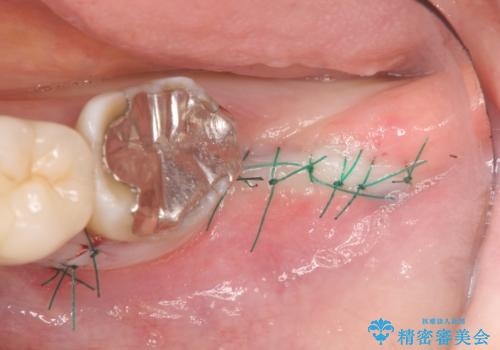 歯の破折による抜歯　インプラントによる咬合機能回復の治療中