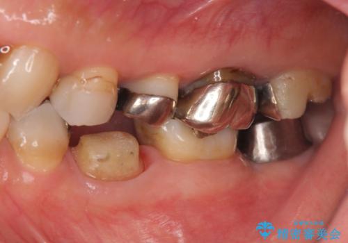 歯の破折による抜歯 インプラントによる咬合機能回復の治療中