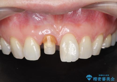 前歯の変色 セラミック審美補綴の治療中