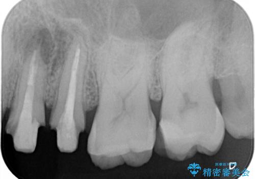 体調が悪いと腫れる　根管治療とセラミック治療の治療中