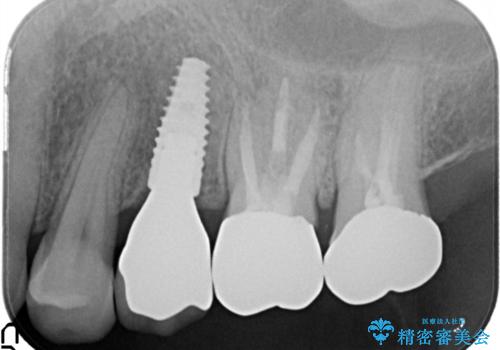 小臼歯部のインプラントの症例 治療後