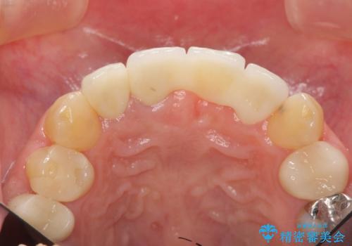 不良インプラントの除去・骨造成・歯肉移植・前歯審美セラミックブリッジ製作の治療後