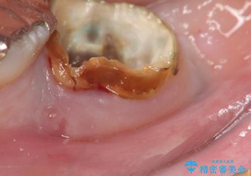 歯の破折による抜歯 インプラントによる咬合機能回復の治療中