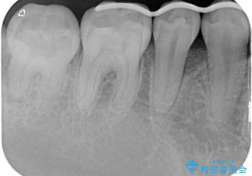 このままでは抜歯と言われた 失われた骨の再生治療 の治療中