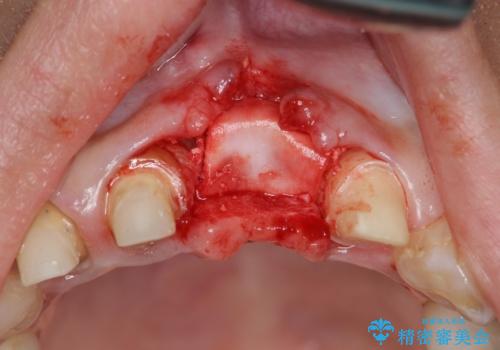 不良インプラントの除去・骨造成・歯肉移植・前歯審美セラミックブリッジ製作の治療中