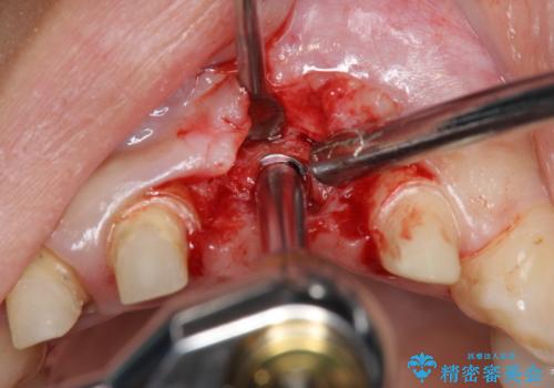 不良インプラントの除去・骨造成・歯肉移植・前歯審美セラミックブリッジ製作の治療前