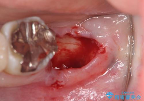 歯の破折による抜歯 インプラントによる咬合機能回復の治療後