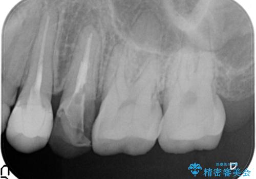 歯肉の中までの深い虫歯 部分矯正後のセラミック治療の治療前