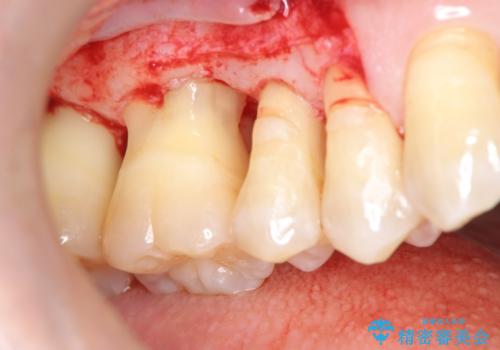 [歯周病治療]　再生療法　歯肉弁根尖側移動術の治療中