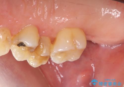 部分矯正を含む 歯周病治療 (再生治療・歯周ポケット除去・MTM・連結補綴)の治療中