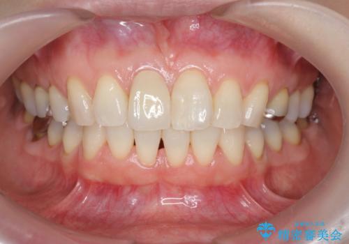 前歯の変色 セラミック審美補綴の治療後