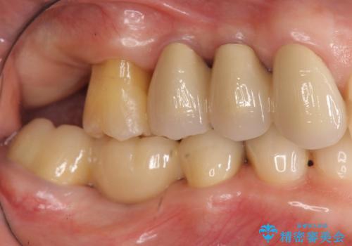 部分矯正を含む 歯周病治療 (再生治療・歯周ポケット除去・MTM・連結補綴)の治療後