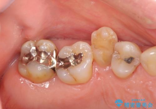 部分矯正を含む 歯周病治療 (再生治療・歯周ポケット除去・MTM・連結補綴)の治療前
