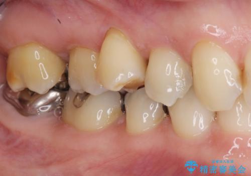 部分矯正を含む 歯周病治療 (再生治療・歯周ポケット除去・MTM・連結補綴)の治療前