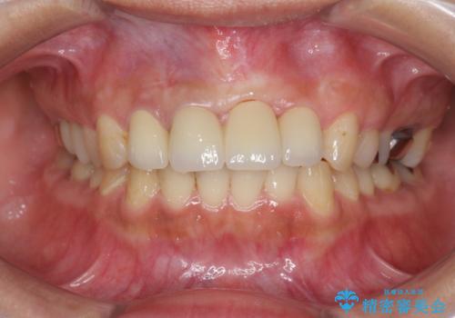 不良インプラントの除去・骨造成・歯肉移植・前歯審美セラミックブリッジ製作の治療後