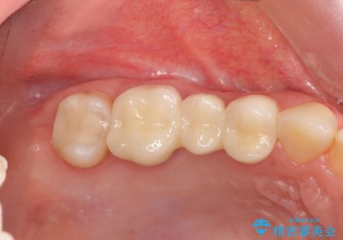 [深い虫歯] 根管治療・歯周外科治療を行い歯を保存するの治療後