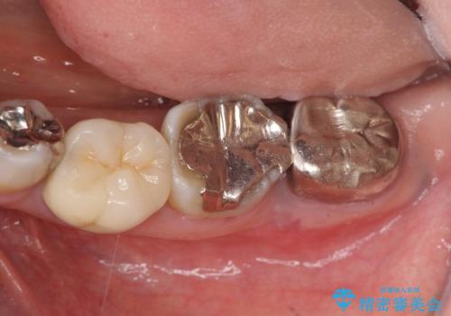 歯の破折による抜歯 インプラントによる咬合機能回復の治療前