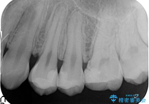 精密なむし歯の治療 セラミックインレーの治療後