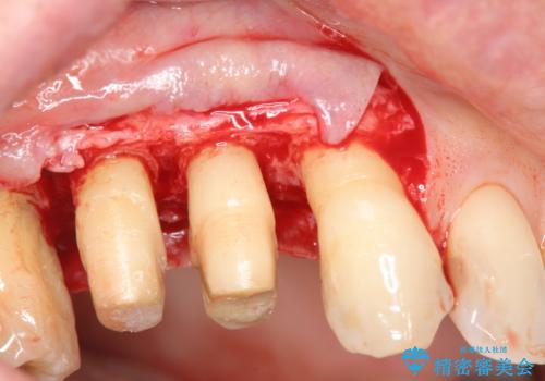 部分矯正を含む 歯周病治療 (再生治療・歯周ポケット除去・MTM・連結補綴)の治療中