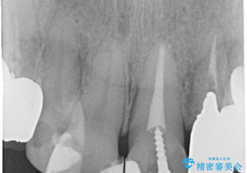 セラミックと矯正を併用してきれいな前歯への治療前