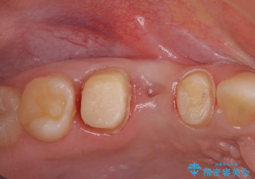 [深い虫歯] 根管治療・歯周外科治療を行い歯を保存するの治療前