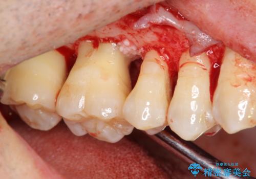 [歯周病治療]　再生療法　歯肉弁根尖側移動術の治療前