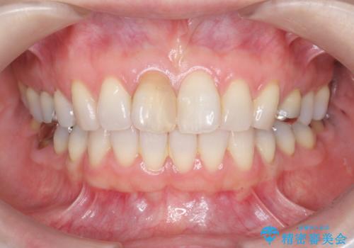 前歯の変色 セラミック審美補綴の治療前