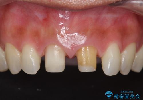 短期集中  前歯審美治療の治療中