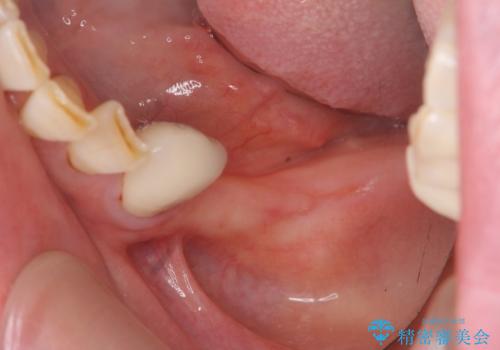歯を失い噛めない、インプラントによる咬合機能回復の治療前