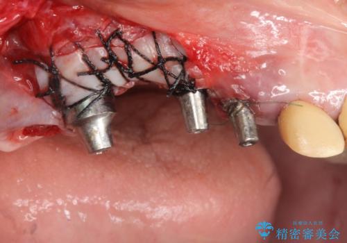 他院で中途半端に終わってしまったインプラント治療 の治療中