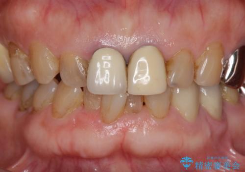 前歯の審美改善の治療前