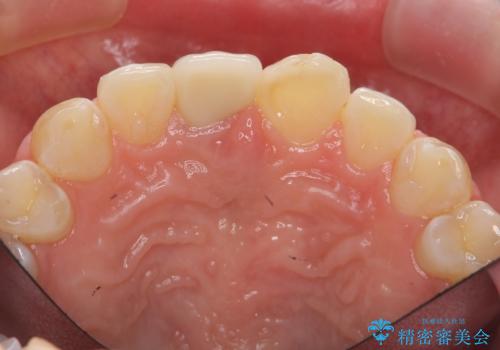 前歯をきれいにしたい ジルコニアクラウンによる審美治療の治療後