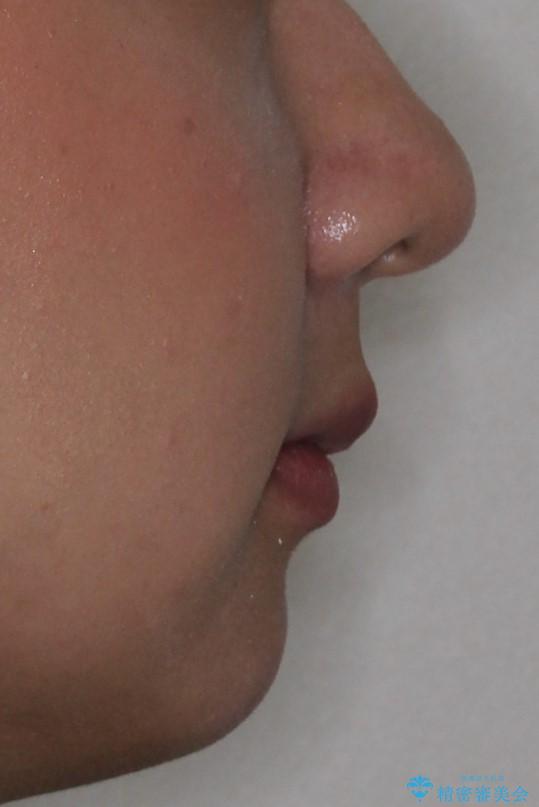 抜歯矯正で口元に変化を ラビアル・ワイヤー矯正でEラインの治療後(顔貌)