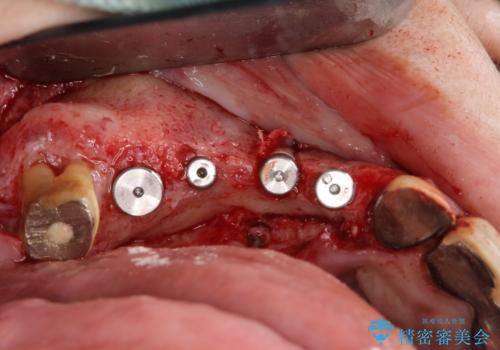 他院で中途半端に終わってしまったインプラント治療 の治療後