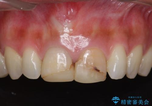 短期集中  前歯審美治療の症例 治療前