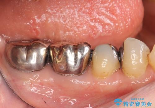 オールセラミッククラウン PGA(ゴールド)クラウン 古い銀歯の治療の治療前