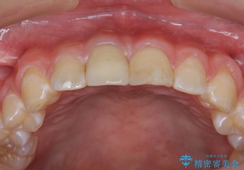 前歯をきれいにしたい ジルコニアクラウンによる審美治療の治療後